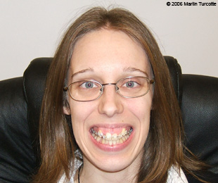 Marie-Hélène Cyr - Before orthognathic surgeries (October 2006)